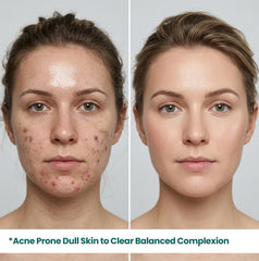 Side-by-side comparison of acne-prone dull skin becoming a clear, balanced, and glowing complexion with HerbaNutrix 2% Salicylic Acid treatment.