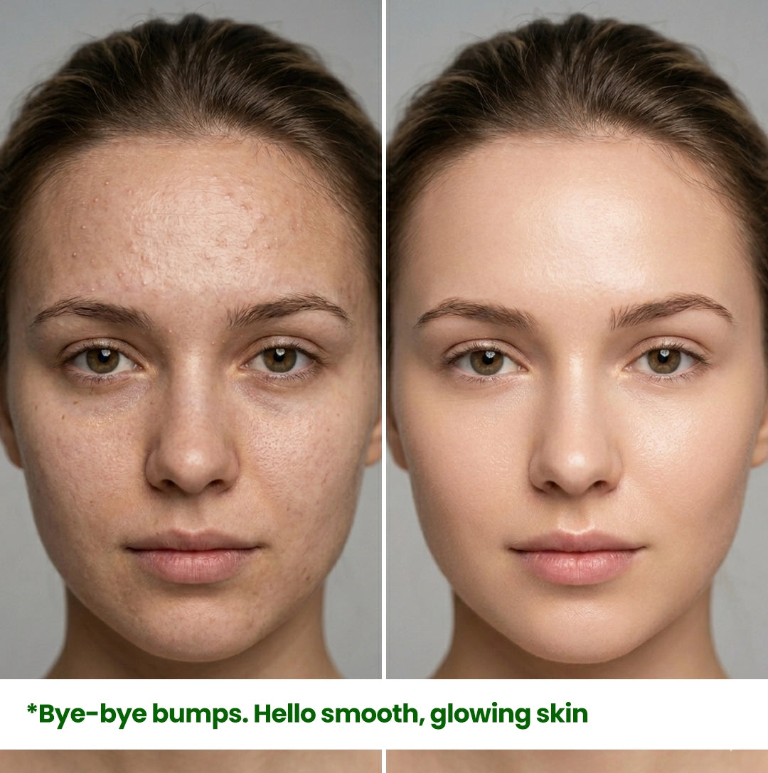 A before and after skin transformation using HerbaNutrix 12% Niacinamide serum, showing a visible reduction in small forehead bumps and the achievement of a smooth, healthy glowing complexion.