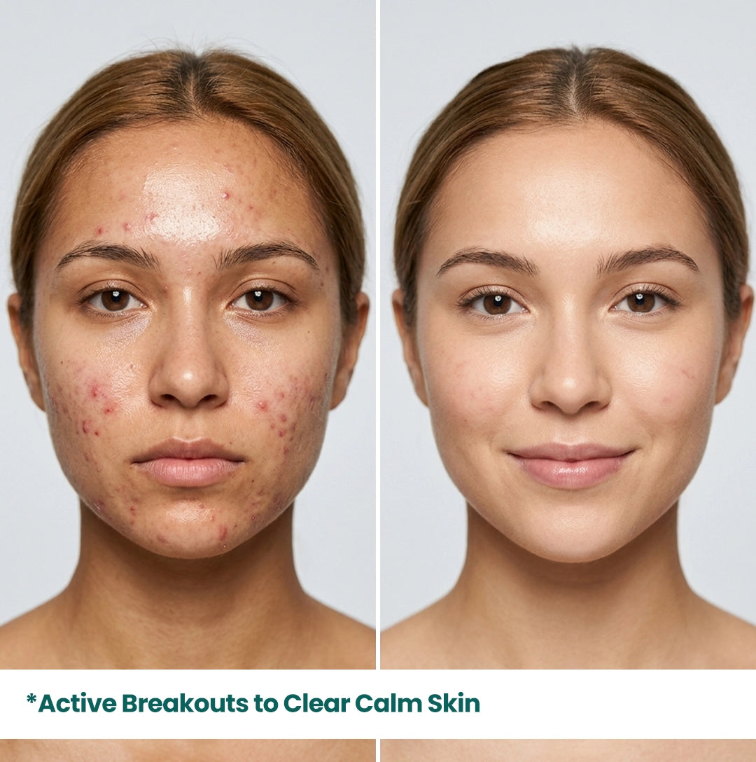 eal before and after results showing transformation from active acne breakouts to clear, calm skin using HerbaNutrix Acne Defense Serum.