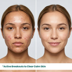 eal before and after results showing transformation from active acne breakouts to clear, calm skin using HerbaNutrix Acne Defense Serum.